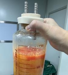 琼海水动力吸脂手术要做多久？